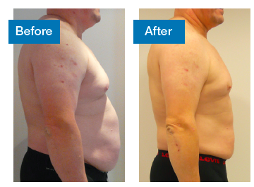3d-Lipo Before/After